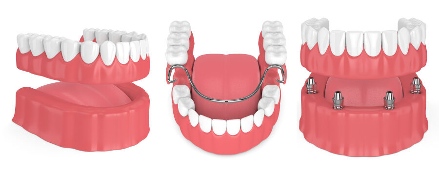 Illustrations of full, partial, and implant-supported dentures