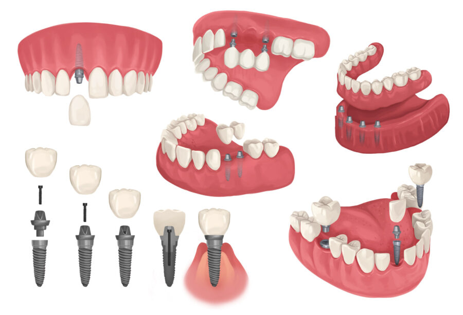 Illustrations of different configurations of dental implants to replace missing teeth