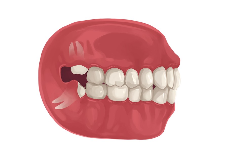 Illustration of problematic wisdom teeth growing in crooked that need to be extracted