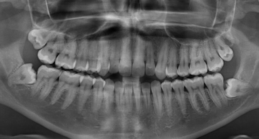 Panoramic X-ray of the mouth showing 4 wisdom teeth that need to be removed