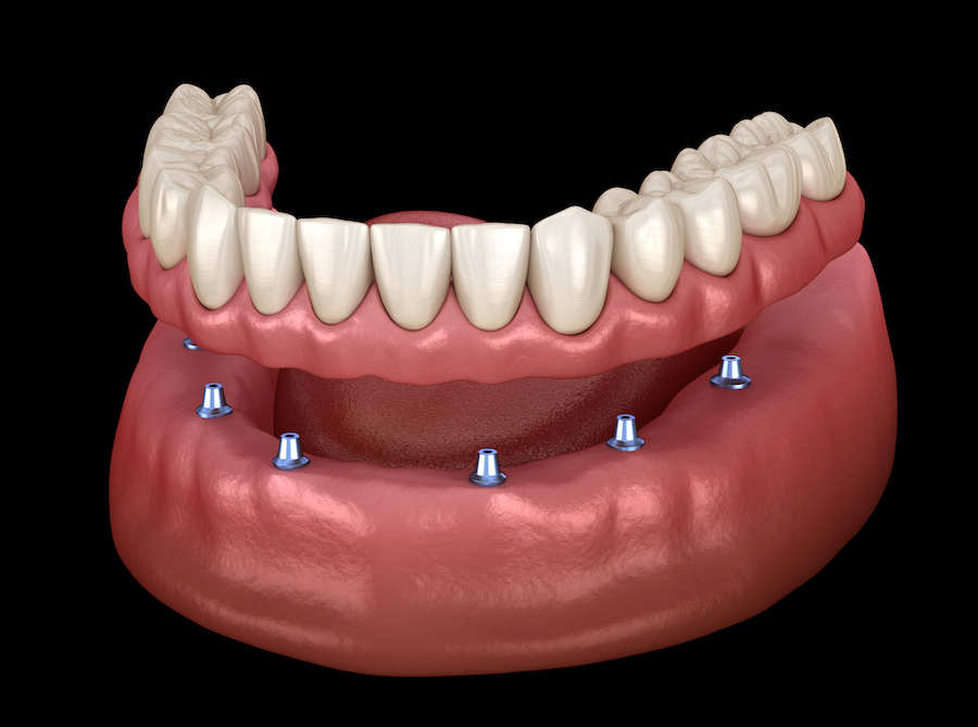 dental implant, denture, denture care, dental implant care, implant supported denture